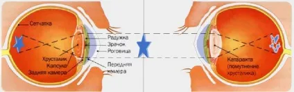 Катаракта, meddoc