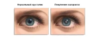 Катаракта, meddoc
