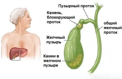 Камінь в жовчному міхурі чи робити операцію, як жити (міхурі) Камінь в жовчному міхурі чи робити операцію, як жити