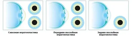 Кератопластика суть процедури і результати пересадки рогівки (пересадки) Кератопластика суть процедури і результати пересадки рогівки