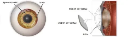 Кератопластика суть процедури і результати пересадки рогівки (рогівки) Кератопластика суть процедури і результати пересадки рогівки