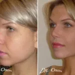 Кісткова мозоль після ринопластики - фото, як виглядає і як прибрати (ринопластики) Кісткова мозоль після ринопластики - фото, як виглядає і як прибрати