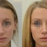 Кісткова мозоль після ринопластики - фото, як виглядає і як прибрати (мозоль) Кісткова мозоль після ринопластики - фото, як виглядає і як прибрати