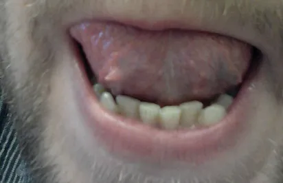 Кондиломи на мові фото, причини, видалення, нарости на шкірі (кондиломи) Кондиломи на мові фото, причини, видалення, нарости на шкірі