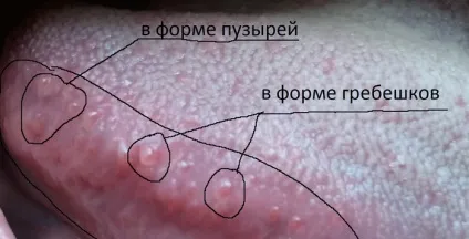 Кондиломи на мові фото, причини, видалення, нарости на шкірі (видалення) Кондиломи на мові фото, причини, видалення, нарости на шкірі