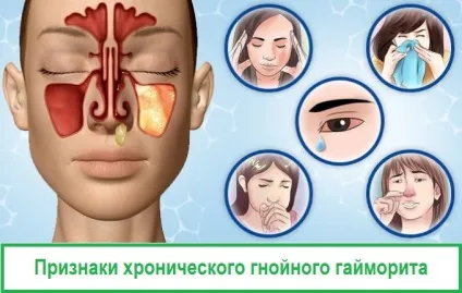 Коричневі соплі з носа у дорослого - чому вони такого кольору (дорослого) Коричневі соплі з носа у дорослого - чому вони такого кольору