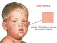 Краснуха фото висипу у дітей і дорослих, симптоми і перші ознаки, лікування (дітей) Краснуха фото висипу у дітей і дорослих, симптоми і перші ознаки, лікування