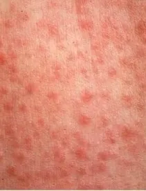 Краснуха фото висипу у дітей і дорослих, симптоми і перші ознаки, лікування (фото) Краснуха фото висипу у дітей і дорослих, симптоми і перші ознаки, лікування