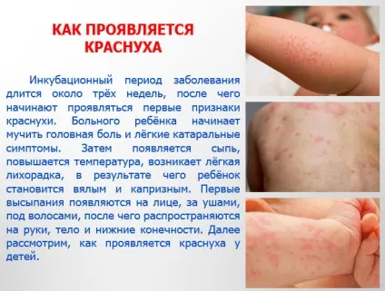Краснуха - фото з особливостями проявів хвороби (краснуха) Краснуха - фото з особливостями проявів хвороби