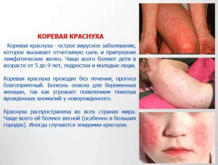 Краснуха - фото з особливостями проявів хвороби (краснуха) Краснуха - фото з особливостями проявів хвороби