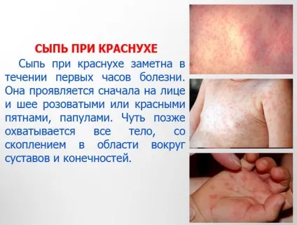 Краснуха - фото з особливостями проявів хвороби (краснуха) Краснуха - фото з особливостями проявів хвороби