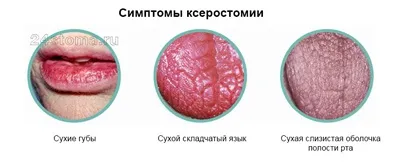 Ксеростомія, або сухість у роті причини, симптоми, лікування