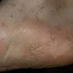 Лікування псоріазу перекисом водню, як лікувати псоріаз за методом Неумивакіна