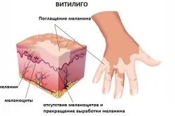 Лікування вітіліго народними засобами (народними) Лікування вітіліго народними засобами
