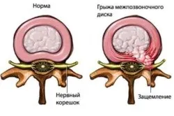 Лікування міжхребцевої грижі ефективні методи (грижі міжхребцевого диска) Лікування міжхребцевої грижі ефективні методи