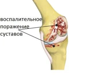 Лікування артриту - антибіотики, уколи, ін'єкції, електрофорез і фізіопроцедури при ревматоїдному (електрофорез) Лікування артриту - антибіотики, уколи, ін'єкції, електрофорез і фізіопроцедури при ревматоїдному