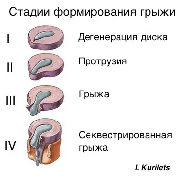 Лікування міжхребцевої грижі, Луганська обласна клінічна лікарня (грижі) Лікування міжхребцевої грижі, Луганська обласна клінічна лікарня