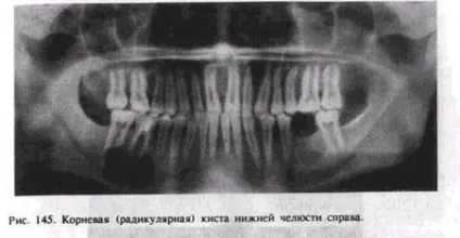 Лікування полягає в резекції щелепи (студопедія) Лікування полягає в резекції щелепи