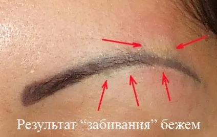 Лазерне видалення татуажу брів - відгуки, ціни, фото до і після (лазерне) Лазерне видалення татуажу брів - відгуки, ціни, фото до і після