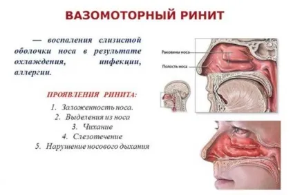 Лікування лазером вазомоторного риніту - свідчення, процедура і наслідки (лікування) Лікування лазером вазомоторного риніту - свідчення, процедура і наслідки