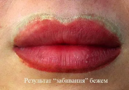 Лазерне видалення татуажу брів - відгуки, ціни, фото до і після (брів) Лазерне видалення татуажу брів - відгуки, ціни, фото до і після