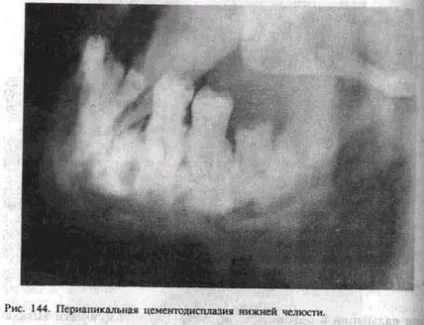 Лікування полягає в резекції щелепи (посібник) Лікування полягає в резекції щелепи
