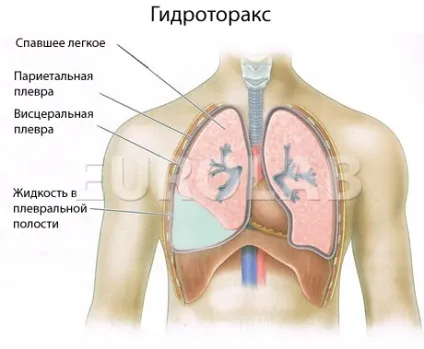 Лікування гидроторакса легких - медичний портал eurolab (лікарем лікування гидроторакса) Лікування гидроторакса легких - медичний портал eurolab