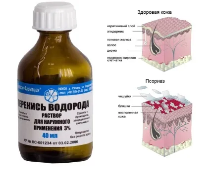 Лікування псоріазу перекисом водню відгуки (псоріазу) Лікування псоріазу перекисом водню відгуки