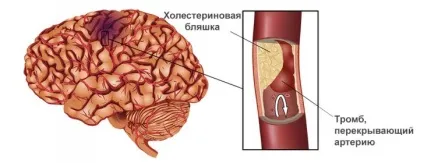 Мікроінсульт ознаки, причини, діагностика, лікування, невідкладна допомога при мікроінсульт, (мікроінсульт) Мікроінсульт ознаки, причини, діагностика, лікування, невідкладна допомога при мікроінсульт,