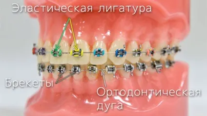 Металеві лігатурні брекети - ціни на металеві лігатурні брекет-системи - (лігатурні) Металеві лігатурні брекети - ціни на металеві лігатурні брекет-системи -