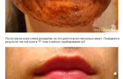 Медові маски від прищів (медові) Медові маски від прищів