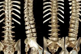Мрт або кт хребта що краще і в чому різниця (хребта) Мрт або кт хребта що краще і в чому різниця
