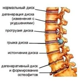 Мрт або кт хребта що краще і в чому різниця (хребта) Мрт або кт хребта що краще і в чому різниця