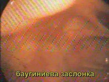 Недостатність баугиниевой заслінки лікування (недостатність баугиниевой заслінки) Недостатність баугиниевой заслінки лікування