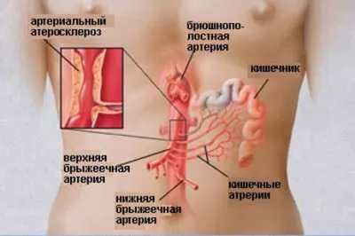 Некроз кишечника причини, симптоми, лікування (симптоми) Некроз кишечника причини, симптоми, лікування