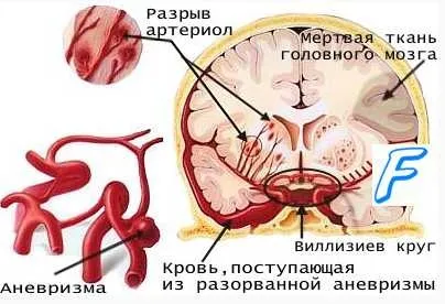 Невідкладна допомога при геморагічному інсульті - лікування серця (інсульті) Невідкладна допомога при геморагічному інсульті - лікування серця