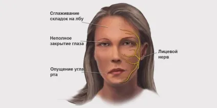 Неврит лицьового нерва симптоми і лікування масажем і гімнастикою у дітей (симптоми) Неврит лицьового нерва симптоми і лікування масажем і гімнастикою у дітей