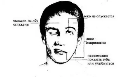 Неврит лицьового нерва