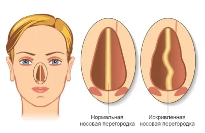 Носова перегородка деформація, травми і їх лікування (викривлення носової перегородки) Носова перегородка деформація, травми і їх лікування