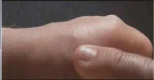 Освіта шишок під шкірою і на руках види ущільнень, причини, симптоми і рекомендований лікування (шишок) Освіта шишок під шкірою і на руках види ущільнень, причини, симптоми і рекомендований лікування
