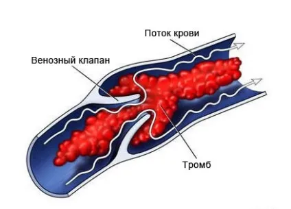 Обширний інфаркт міокарда симптоми - лікування серця (симптоми) Обширний інфаркт міокарда симптоми - лікування серця