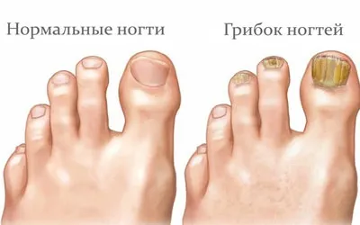 Оніхомікоз нігтів лікування в домашніх умовах