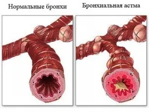 13 Рецептів лікування алергічної астми народними засобами (алергічної) 13 Рецептів лікування алергічної астми народними засобами