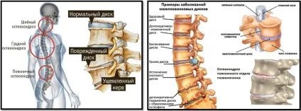Остеохондроз і бодібілдинг