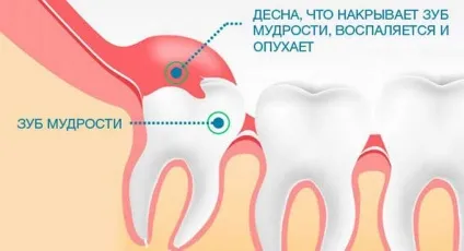 Перикороніт причини і лікування в клінічних і домашніх умовах (перикороніт) Перикороніт причини і лікування в клінічних і домашніх умовах