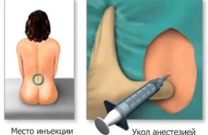 Чому я відмовилася від епідуральної анестезії при пологах і вам раджу! (Боляче робити) Чому я відмовилася від епідуральної анестезії при пологах і вам раджу!