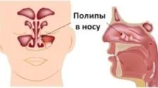 Підслизова вазотомія нижніх носових раковин види, фото, відео, відгуки (підслизова) Підслизова вазотомія нижніх носових раковин види, фото, відео, відгуки