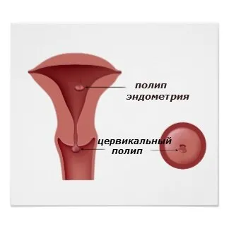 Поліпи в матці причини, симптоми, лікування, фото (фото) Поліпи в матці причини, симптоми, лікування, фото