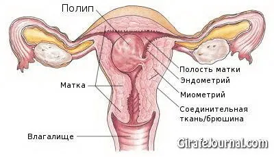 Поліпи в матці причини, симптоми, лікування, фото (причини) Поліпи в матці причини, симптоми, лікування, фото