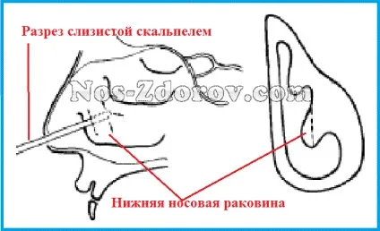 Підслизова вазотомія нижніх носових раковин види, фото, відео, відгуки (підслизова) Підслизова вазотомія нижніх носових раковин види, фото, відео, відгуки